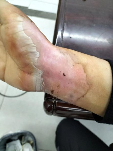 烧伤非物质文化遗产（烧伤非物质文化遗产名录有哪些）-第3张图片-八三百科