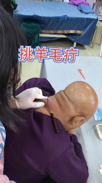 挑羊毛疔非物质文化遗产（挑羊毛疔是国家级非遗吗）-第2张图片-八三百科