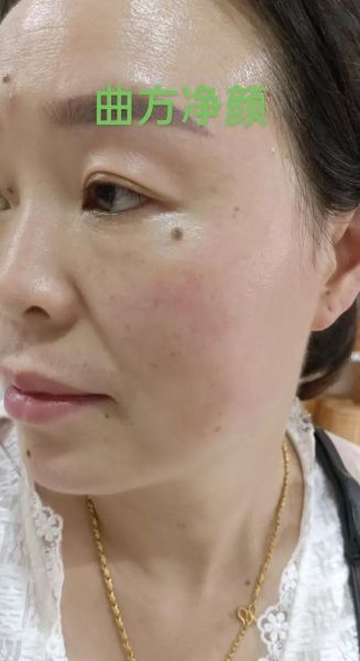 非物质文化遗产痣（非遗点痣技艺是什么）-第2张图片-八三百科