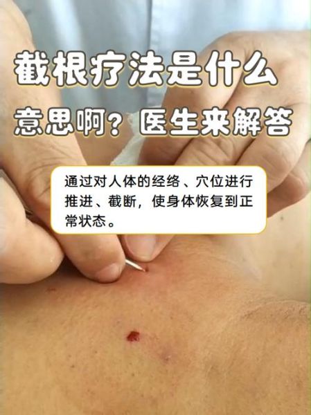 非物质文化遗产 截根术（截根术是什么 新手三分钟看懂）-第1张图片-八三百科