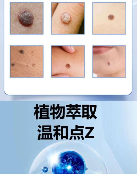 中药点痣非物质文化遗产（中药点痣是正宗非遗还是噱头）-第2张图片-八三百科