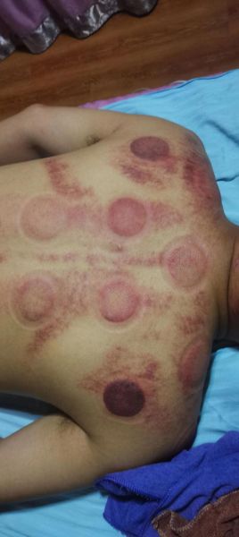 非物质文化遗产刮痧（刮痧真的是非物质文化遗产吗）-第2张图片-八三百科