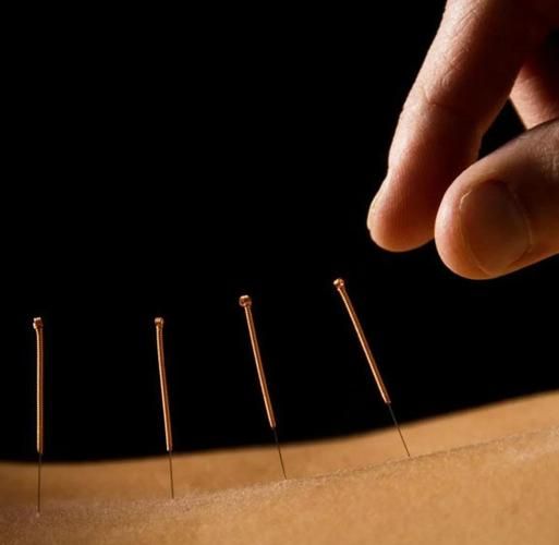 针灸非物质文化遗产（针灸为什么被列入非遗）-第1张图片-八三百科